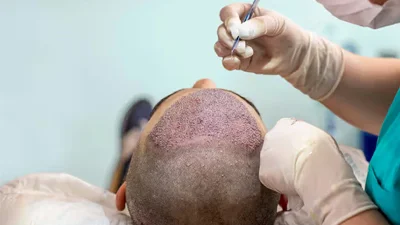 Hair Restoration Surgery